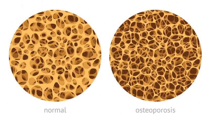 Knochenvergleich - normal und osteoporosis