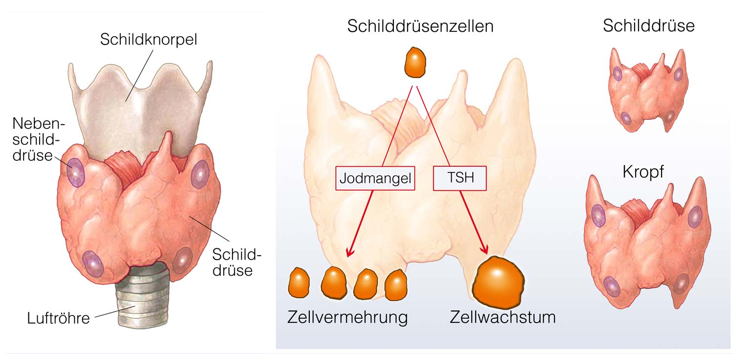 Grafik Schilddrüse / Kropf